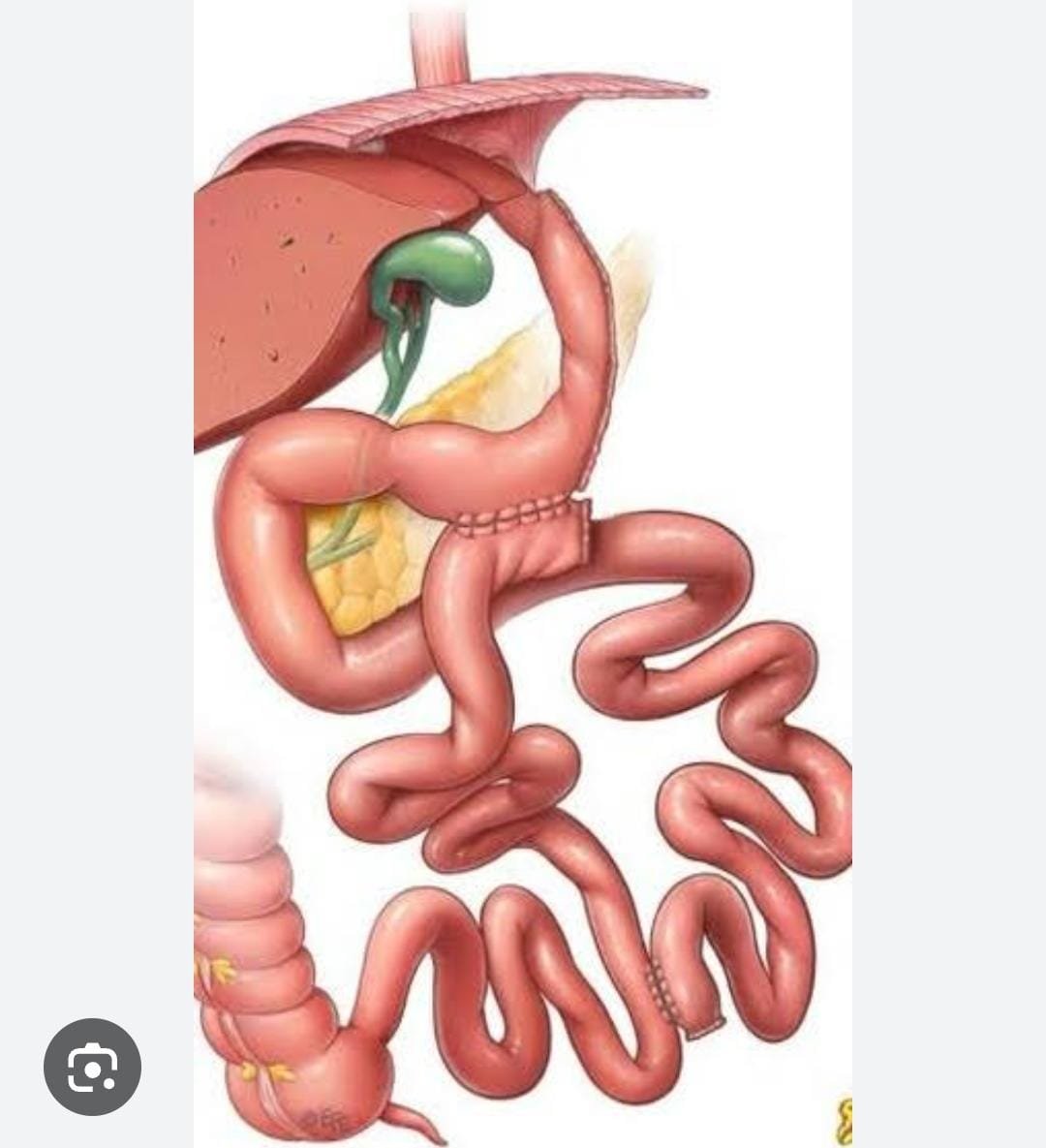 Bipartición Intestinal tipo Santoro